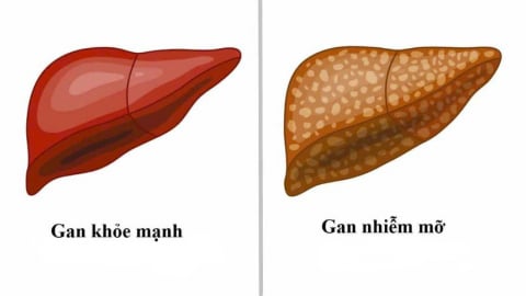 Người bị gan nhiễm mỡ: Tiêu thụ thực phẩm như thế nào để không cần dùng thuốc?