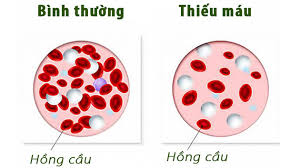 Ăn đa dạng - giải pháp tự nhiên cho người thiếu máu và thiếu sắt