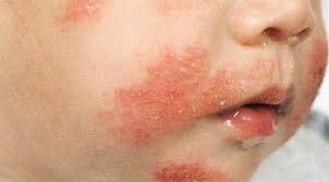 Dị ứng đạm sữa bò: Nhận biết dấu hiệu và phương pháp điều trị hiệu quả cho bé