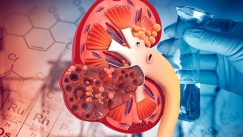 Ghép thận có phải là phương pháp duy nhất để điều trị suy thận?