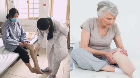 Bạn có nằm trong nhóm dễ bị suy giãn tĩnh mạch?