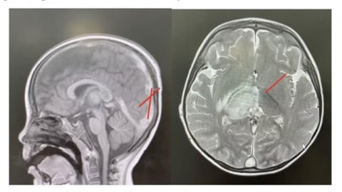 Bé trai mắc huyết khối tĩnh mạch nội sọ nặng do nguyên nhân hiếm gặp