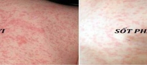 Biến chứng nguy hiểm của bệnh sởi ở trẻ em