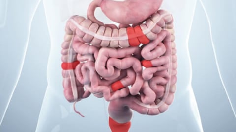 Bệnh Crohn - Sát thủ thầm lặng trong hệ tiêu hóa