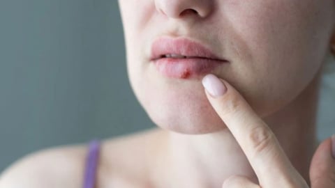 Nhận diện bệnh tình dục qua những thay đổi trên gương mặt