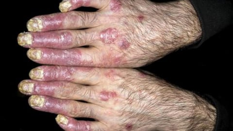 Nhận biết sớm bệnh vảy nến và cách điều trị hiệu quả