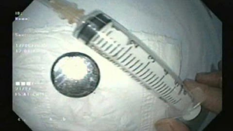 Hải Phòng: Bé 18 tháng tuổi nguy kịch do nuốt pin cúc gây loét thực quản