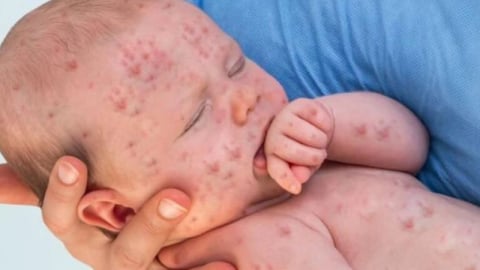 Chăm đúng cách khi trẻ bị sởi: Bí quyết giúp bé khỏe lại an toàn