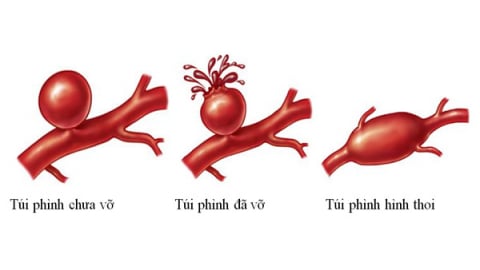 Mắc phình mạch máu não, làm sao để ngủ ngon mỗi đêm?