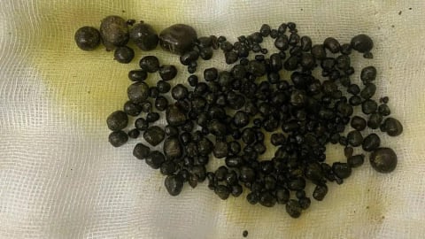 Vĩnh Long: Gắp gần 400 viên sỏi trong túi mật nữ bệnh nhân 47 tuổi