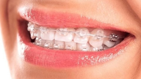 8 lưu ý quan trọng khi niềng răng bạn cần biết