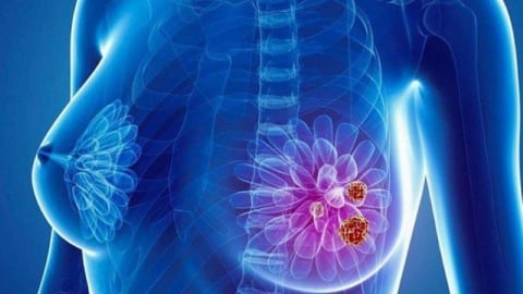 Phục hồi sau cắt bỏ vú: Cần lưu ý những gì?