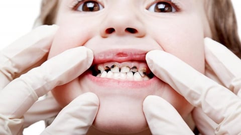 Trẻ bị sâu răng: Cha mẹ nên xử lý thế nào?