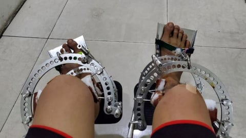 Phẫu thuật tăng chiều cao: Đừng vội quyết định!