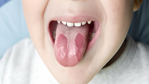 Viêm lưỡi bản đồ - Triệu chứng lành tính nhưng dễ gây lo lắng