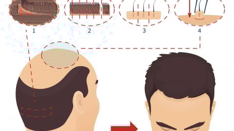 Cấy tóc tự thân: Giải pháp cho người hói đầu