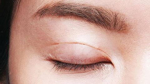Quy trình và thời gian hồi phục sau cắt mí như thế nào?