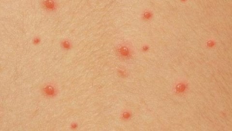 Cảnh báo biến chứng nguy hiểm của bệnh thủy đậu