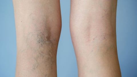 Giãn tĩnh mạch chân: Nhận biết sớm, tránh biến chứng