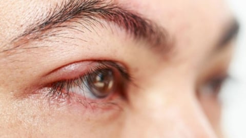 Nguyên nhân lông mi mọc ngược và cách phòng ngừa