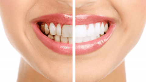 Những tác hại tiềm ẩn khi tẩy trắng răng sai cách