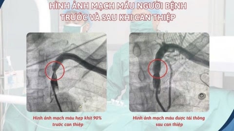 Hải Phòng: Bệnh viện Hữu nghị Việt Tiệp can thiệp thành công hội chứng “ăn cắp máu”, phục hồi tuần hoàn máu lên não cho bệnh nhân cao tuổi