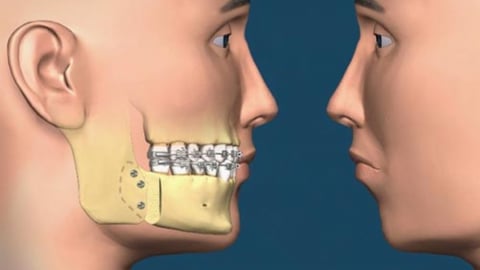 Những điều cần biết về phẫu thuật trượt hàm