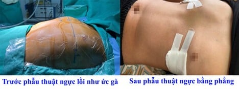 Ngực lồi lên như ức gà, cậu bé 12 tuổi thay đổi ngoại hình ngoạn mục sau khi đến Bệnh viện Đa khoa tỉnh Phú Thọ