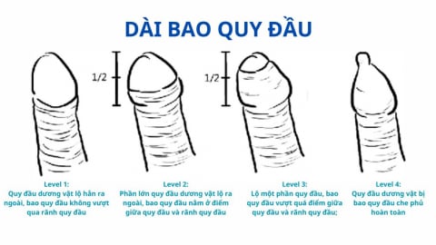 Dài bao quy đầu có thể ảnh hưởng sinh lý nam giới?