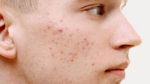Những điều cần biết về mụn nấm men