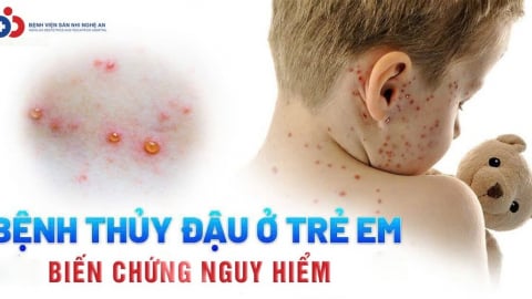 Bệnh viện Sản Nhi Nghệ An điều trị thành công cho bé sơ sinh 15 ngày tuổi bị thủy đậu biến chứng ác tính