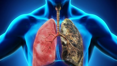 Ô nhiễm không khí làm gia tăng đột biến ung thư phổi ở người không hút thuốc lá