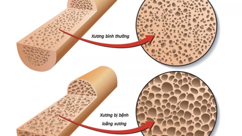 Thiếu vitamin D: 'Căn bệnh âm thầm' dễ bị bỏ qua