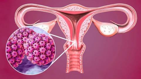 Những yếu tố làm tăng nguy cơ nhiễm HPV, ai cũng cần biết
