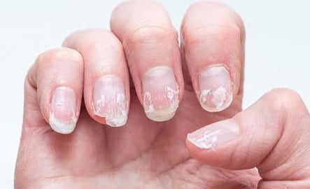 Bổ sung vitamin và khoáng chất nào khi móng tay giòn, dễ gãy?