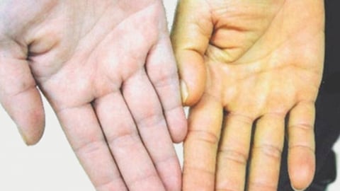 Biểu hiện của viêm gan B giai đoạn đầu: Cảnh báo thầm lặng cần lưu ý