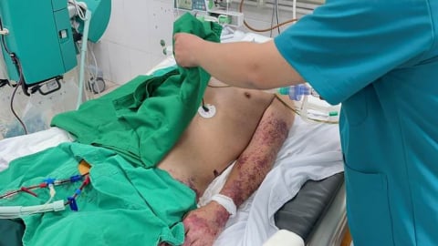 Bộ Y tế khuyến cáo 6 cách phòng, chống bệnh liên cầu lợn