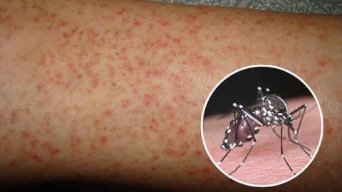 Dự báo gia tăng ca mắc sốt xuất huyết ở Hà Nội
