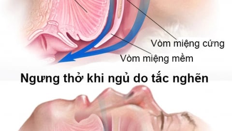Đừng chủ quan với hội chứng ngừng thử khi ngủ
