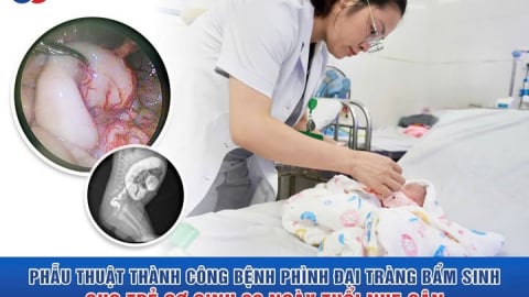 Bệnh viện Sản Nhi Nghệ An phẫu thuật nội soi bệnh phình đại tràng bẩm sinh cho trẻ sơ sinh 30 ngày tuổi nhẹ cân