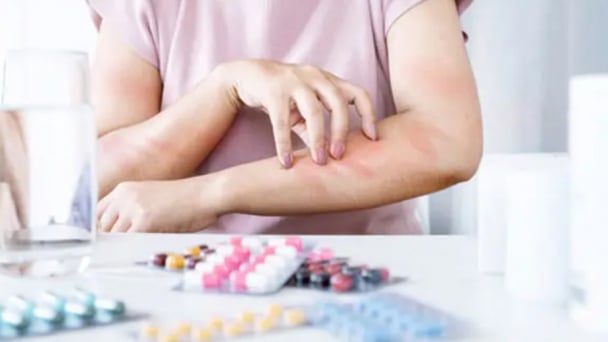 Tại sao có nhiều người dị ứng hải sản?