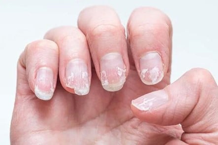 Bổ sung vitamin và khoáng chất nào khi móng tay giòn, dễ gãy?