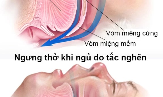 Đừng chủ quan với hội chứng ngừng thử khi ngủ