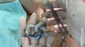 Quảng Nam: Sản phụ sinh thường em bé có dây rốn thắt nút 2 vị trí cách nhau khoảng 10 cm