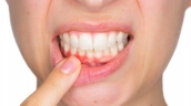 Cách giúp cải thiện tình trạng chảy máu chân răng