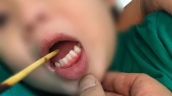Thái Nguyên: Bé trai 3 tuổi nhập viện cấp cứu trong tình trạng 1 que xiên thịt sắc nhọn đâm xuyên lưỡi