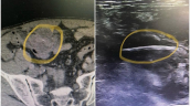 Quảng Ninh: Bệnh nhân 69 tuổi phát hiện mảnh xương dài nhọn xuyên thủng đại tràng gây viêm phúc mạc khi đến khám tại bệnh viện