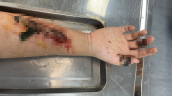 Hà Nội: Thanh niên 17 tuổi đắp lá vào vết thương hở khiến hoại cánh tay và bàn tay