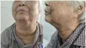 TP. Hồ Chí Minh: Phẫu thuật thành công cho cụ bà 95 tuổi có bướu cổ khổng lồ chèn ép khí quản