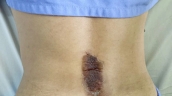 Quảng Ninh: Tự ý đắp lá chữa đau lưng, nam bệnh nhân 39 tuổi bị phồng rộp da